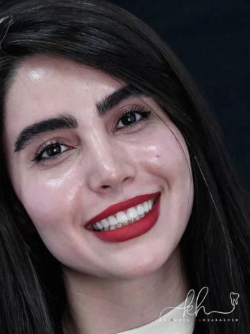 قبل از درمانش رو تو اسلاید اخر میتونی ببینی😌

کامپوزیت ونیر لیرینگ✨
از همون تغی