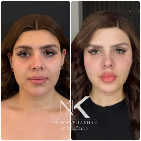 ⁨	البنات الي وجههم بي حجم ويخافون من الحقن شوفوا هاي البنوته عندها خدود بس نفس ا