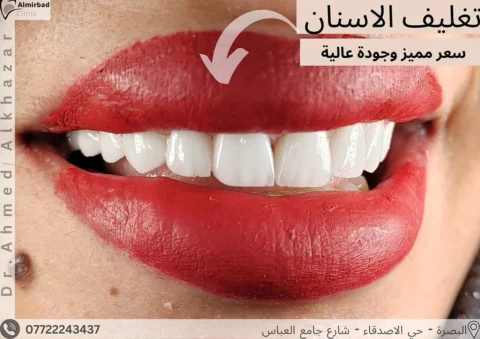 تغليف الاسنان بتركيب الزارگون VIP 
#طب_الأسنان 
#تجميل_الاسنان
#تغليف_الاسنان
#ا