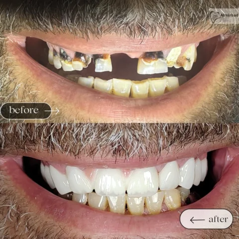 اعادة تأهيل الفك العلوي 
والنتيجة ابتسامة طبيعية 🤍
.
.
للحجز والاستفسار مراجعة 