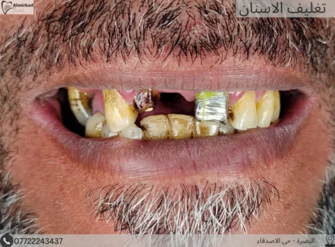 من الظلمات الى النور 🤍🔥
الابتسامة والتفاصيل الطبيعية 
.
.
ازالة التغليفات القد