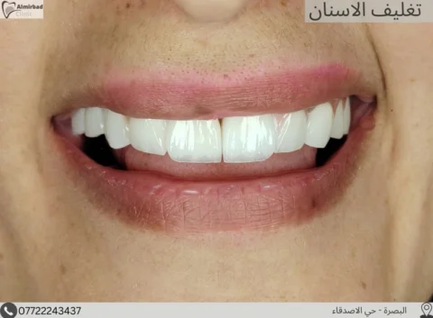 تغليف وزراعة الاسنان المفقودة 
.
.
للحجز والاستفسار 
مراجعة العيادة او على الرقم