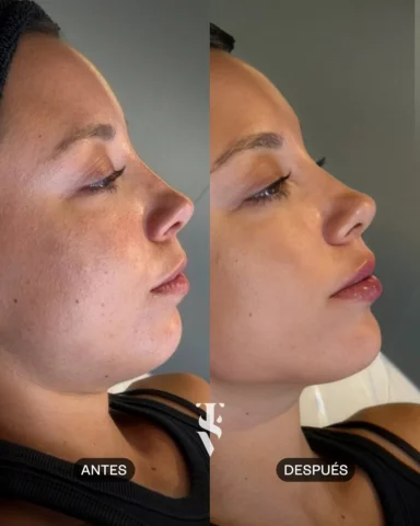 ✨El equilibrio que tu rostro estaba esperando. ✨ Mirá este cambio de perfil… 

✨