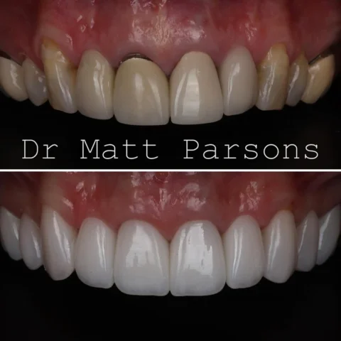 🤩 Porcelain Smile 🤩

This was an example of a case where different dentists ha