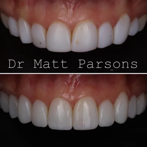 🤩 Composite Replacement 🤩

This patient had had composite placed elsewhere a f