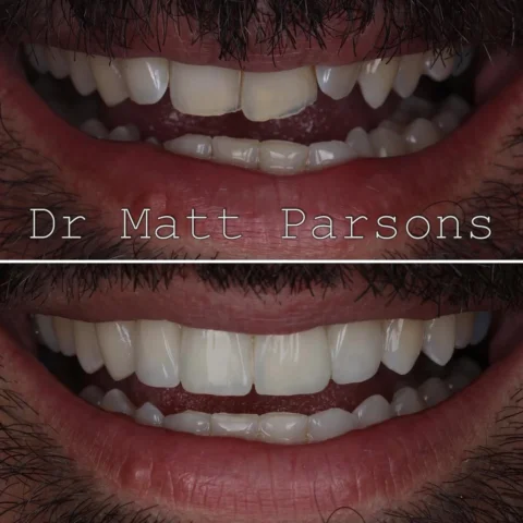 🤩 Invisalign, whitening, bonding 🤩

For this case we decided to play the long 