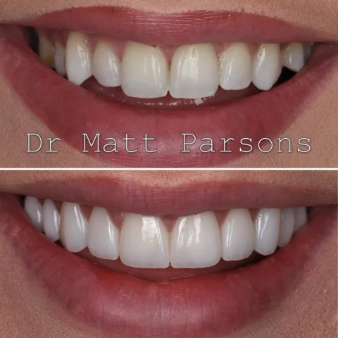 🤩 Porcelain Veneers 🤩

Braces and Invisalign are great, but sometimes patients