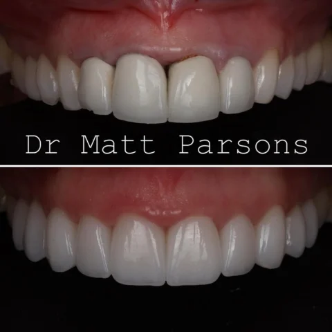 🤩 Replacing old crowns 🤩

This patient had 4 old metal/ceramic crowns. With th