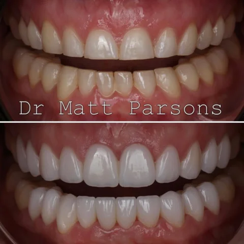 🤩 Porcelain Veneers 🤩

Feeling really proud of this case and so happy for the 