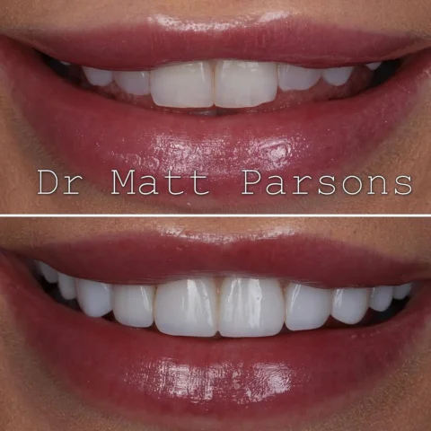 🤩 Composite Bonding 🤩

Direct composite applied to ten teeth here to lift the 