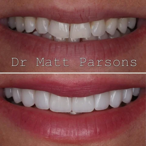 🤩 Porcelain Veneers 🤩

This patient opted for porcelain instead of composite t