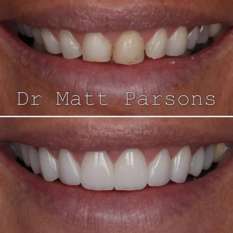 🤩 Porcelain Veneers 🤩

Rolling back the years on this smile - restoring a worn