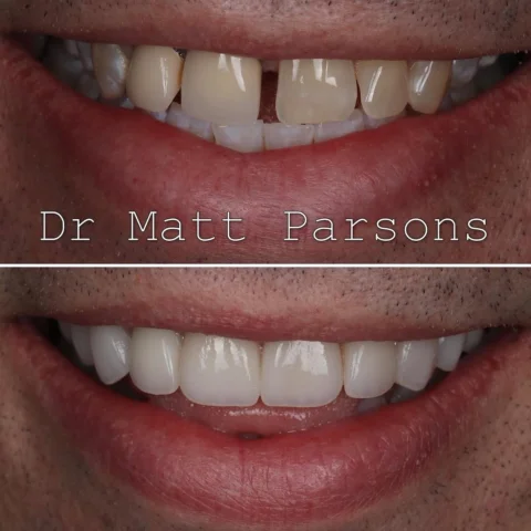 🤩 Porcelain Veneers 🤩

‘I want to get my teeth done, but I don’t want to look 