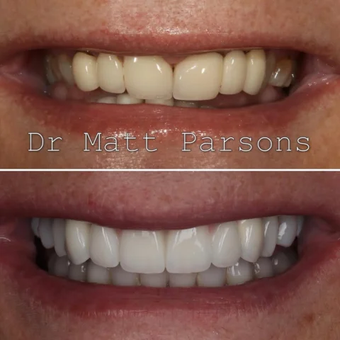 🤩 Smile Makeover 🤩

This was a complicated one on a really deserving patient! 