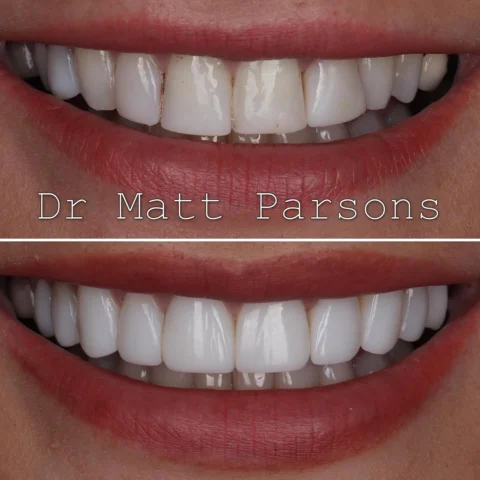 🤩 Replacement Composite Bonding 🤩

This gem of a patient had had composite pla