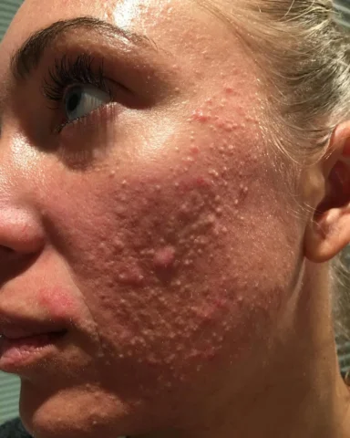Queste foto risalgono al 2015, durante il mio percorso con l’acne cistica, durat