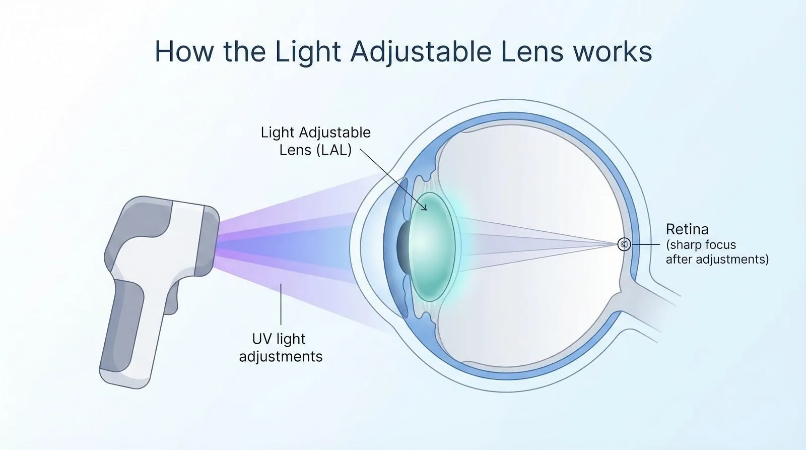 Light Adjustable Lens
