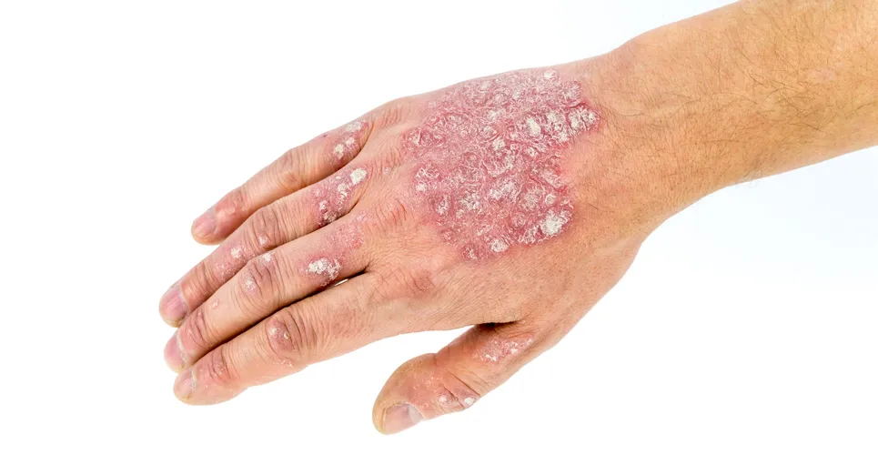 Eczema Treatment in Dubai