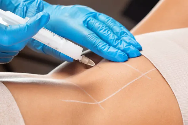 حقن إذابة الدهون في الرياض