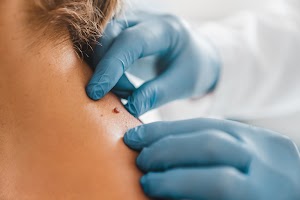 close-up-of-dermatologist-examining-patient-birthm-2023-11-27-05-18-59-utc.jpg