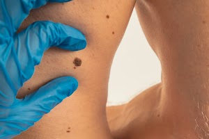 dermatologist-checking-male-birthmarks-for-changin-2024-02-06-20-23-13-utc.jpg