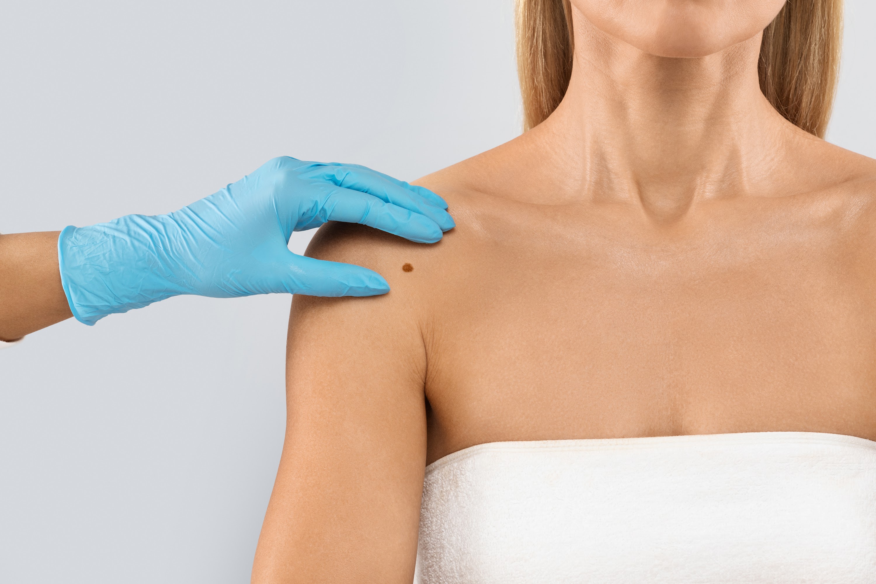 doctor-hand-checking-mole-nevus-on-unrecognizable-2023-11-27-04-59-42-utc.jpg