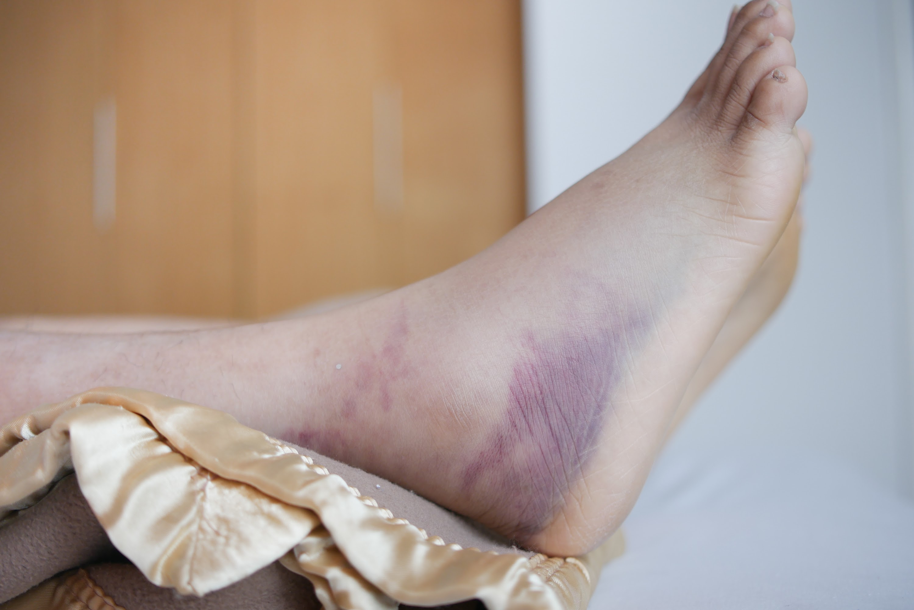 close-up-of-women-feet-with-swelling-2023-11-27-04-53-48-utc.jpg