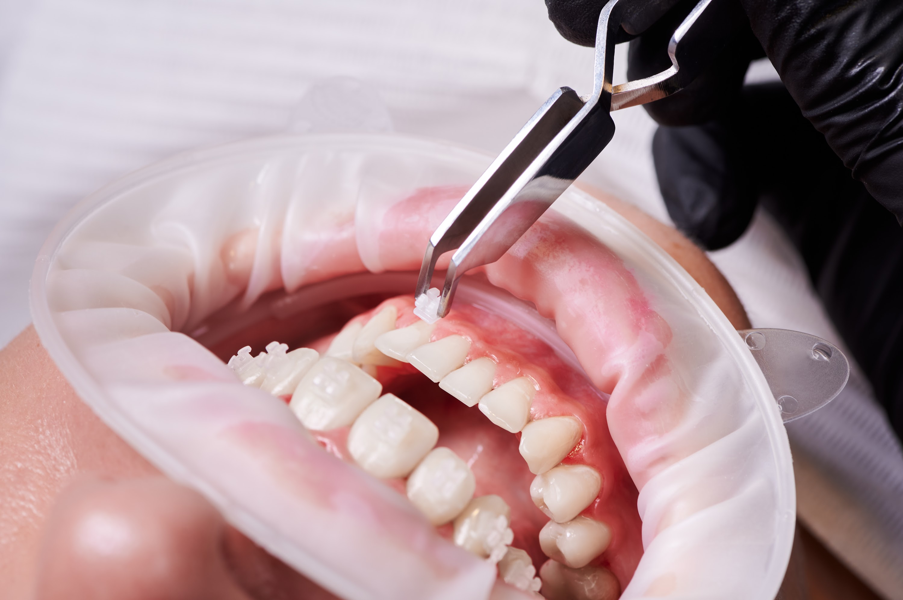 dentist-attaching-orthodontic-brackets-to-patient-2023-11-27-05-16-32-utc.jpg