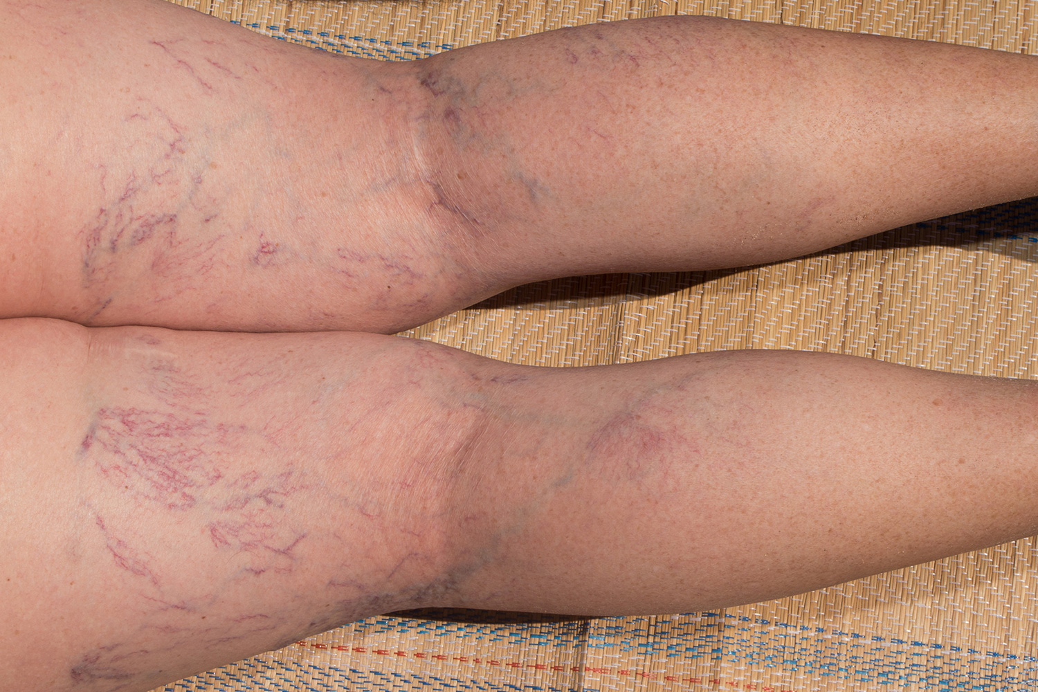 blog-spiderveins.jpg