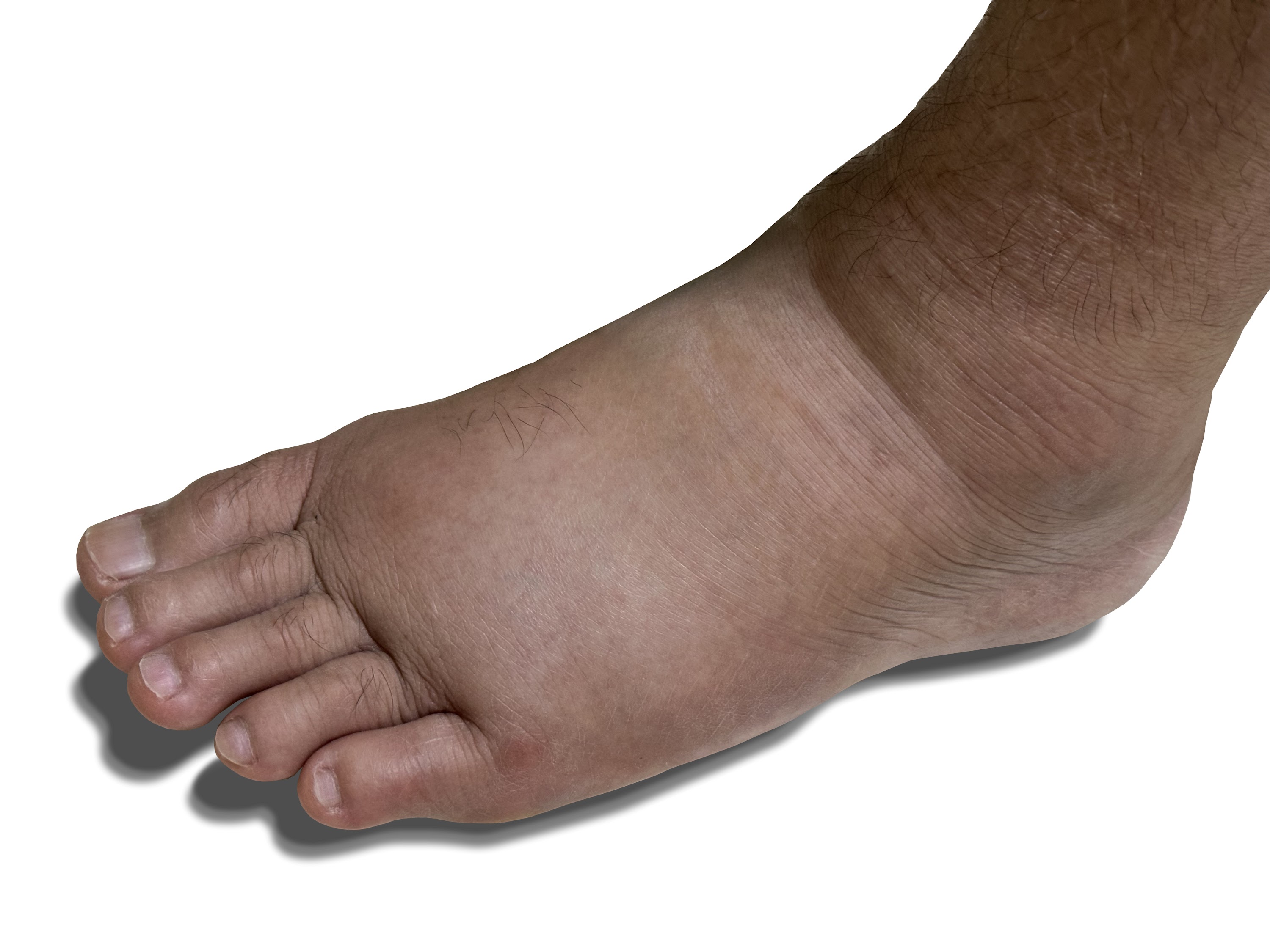 close-up-swollen-left-foot-as-a-result-of-ankle-pa-2024-05-27-01-24-48-utc.jpg