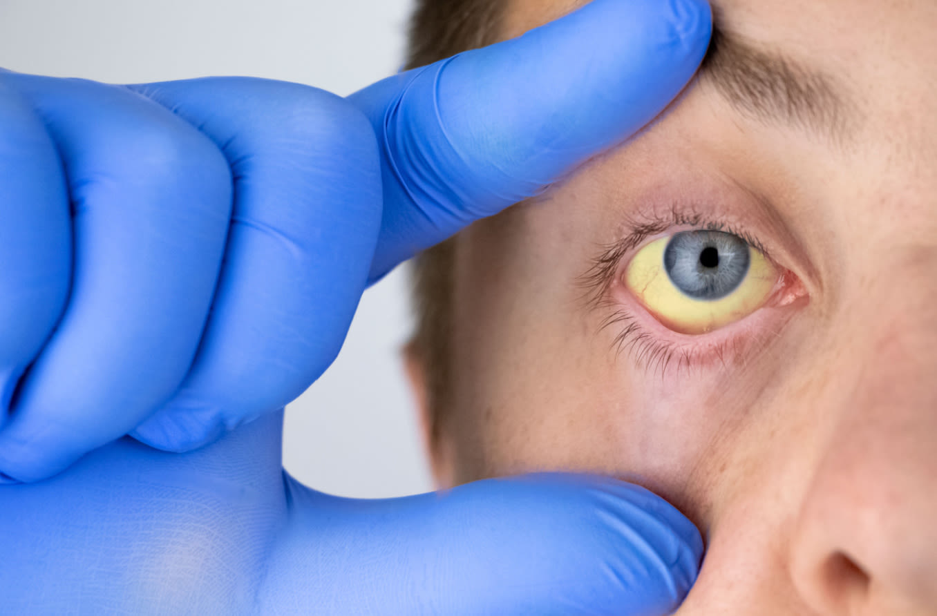 anemic_eyes_hero.jpeg