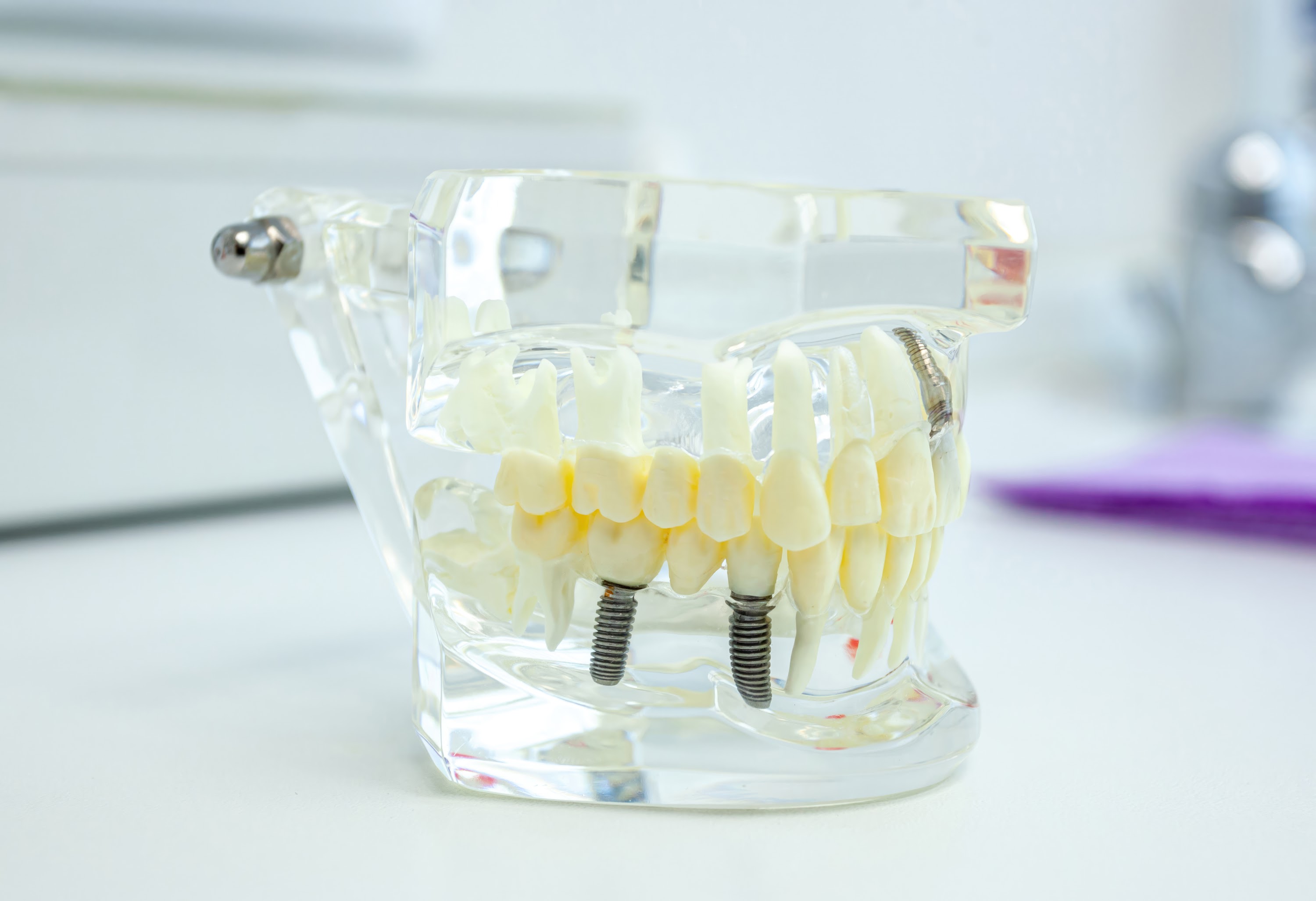 dental-implants-showing-on-anatomical-model-in-cli-2024-12-05-17-35-30-utc.jpg