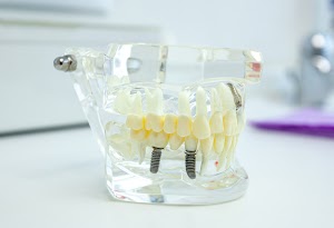 dental-implants-showing-on-anatomical-model-in-cli-2024-12-05-17-35-30-utc.jpg