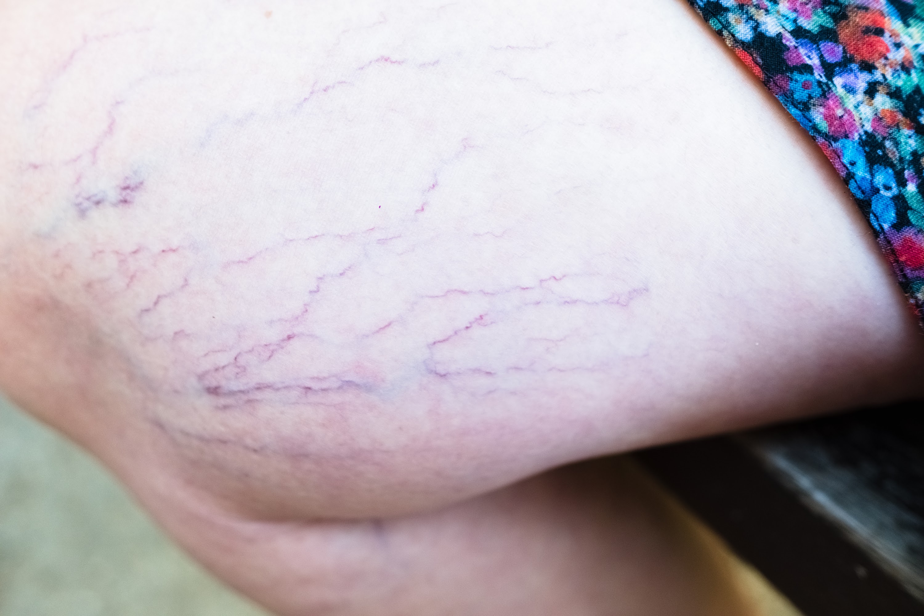 detail-of-varicose-veins-on-the-leg-of-a-seated-wo-2024-10-21-10-14-00-utc.jpg