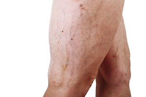 the-disease-varicose-veins-on-a-womans-legs-2023-11-27-05-01-21-utc.jpg