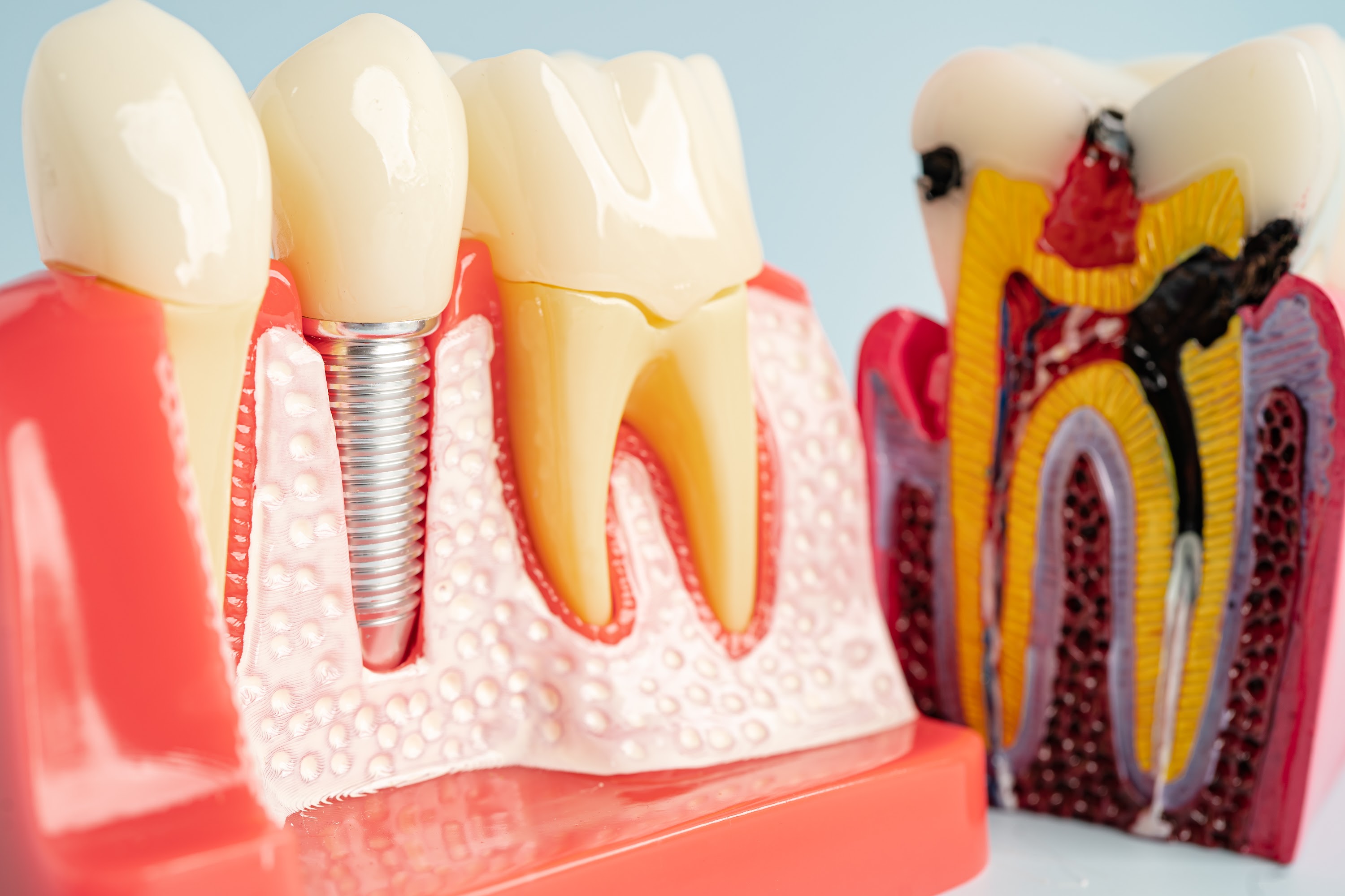 dental-implant-artificial-tooth-roots-into-jaw-r-2024-07-17-20-04-21-utc.jpg