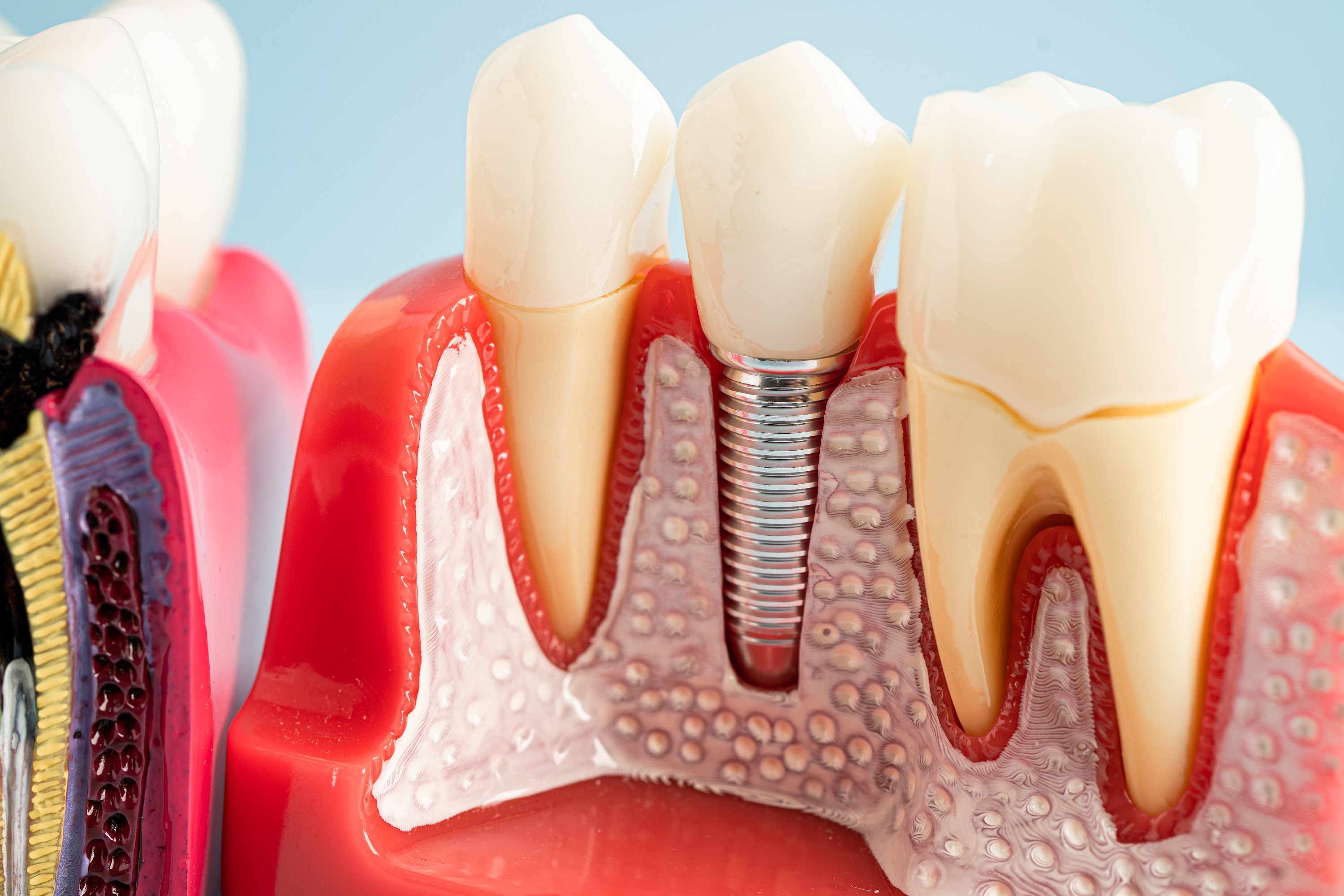 dental-implant-artificial-tooth-roots-into-jaw-r-2025-02-05-20-44-14-utc.jpg