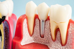 dental-implant-artificial-tooth-roots-into-jaw-r-2025-02-05-20-44-14-utc.jpg