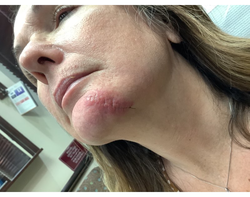 1 week post op chin inferior view.jpg