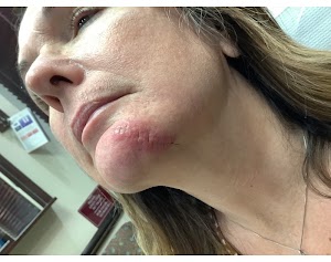 1 week post op chin inferior view.jpg