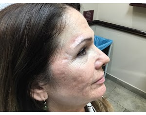 eyebrow post op 11 weeks zoomed out.jpg