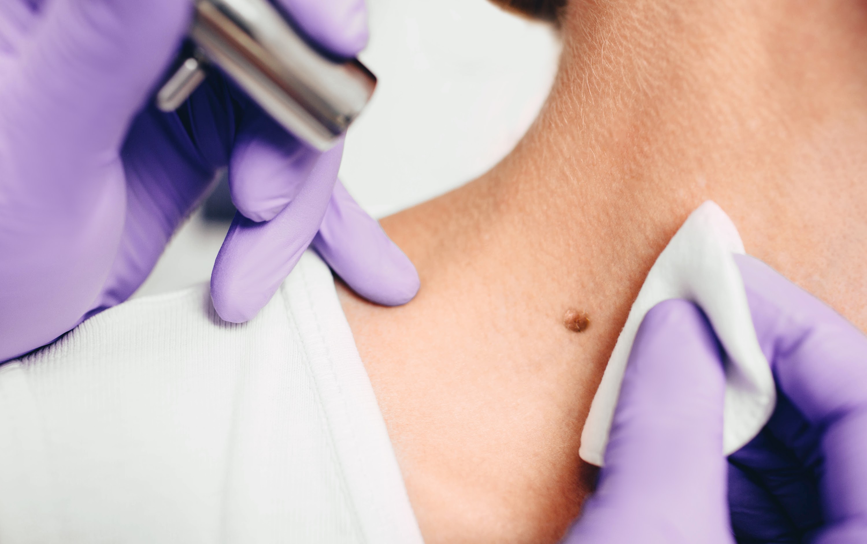 procedure-removing-mole-using-a-medical-laser-2025-03-21-19-21-39-utc.jpg