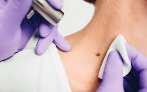 procedure-removing-mole-using-a-medical-laser-2025-03-21-19-21-39-utc.jpg