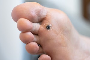 closeup-of-wart-plantar-after-cauterizing-it-with-2025-03-10-05-54-51-utc.jpg