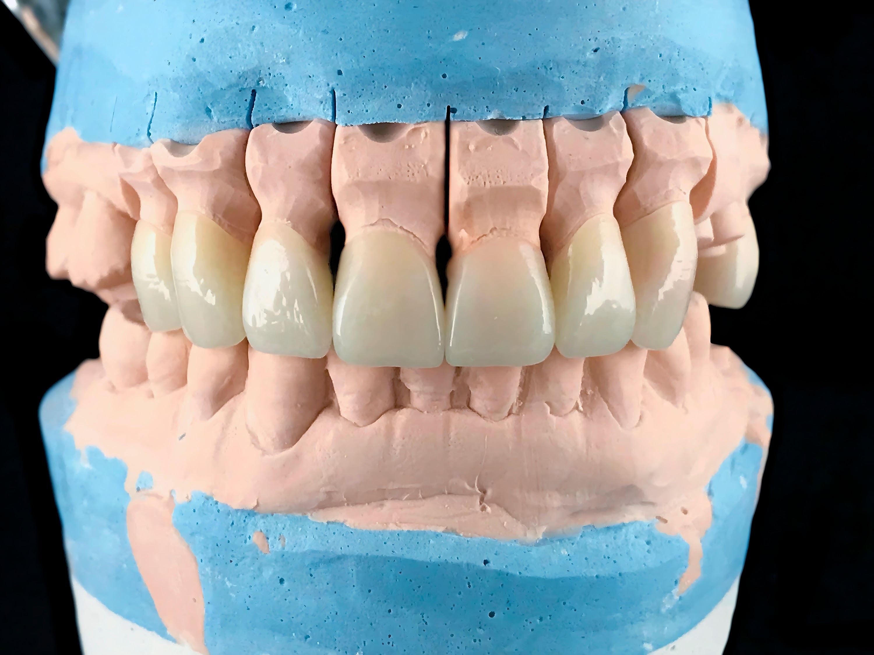 dental-porcelain-prosthesis-implant-tooth-in-denta-2025-02-03-11-45-08-utc.jpeg