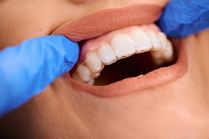 close-up-of-woman-getting-dental-aligner-on-her-te-2024-12-13-17-08-03-utc.jpg