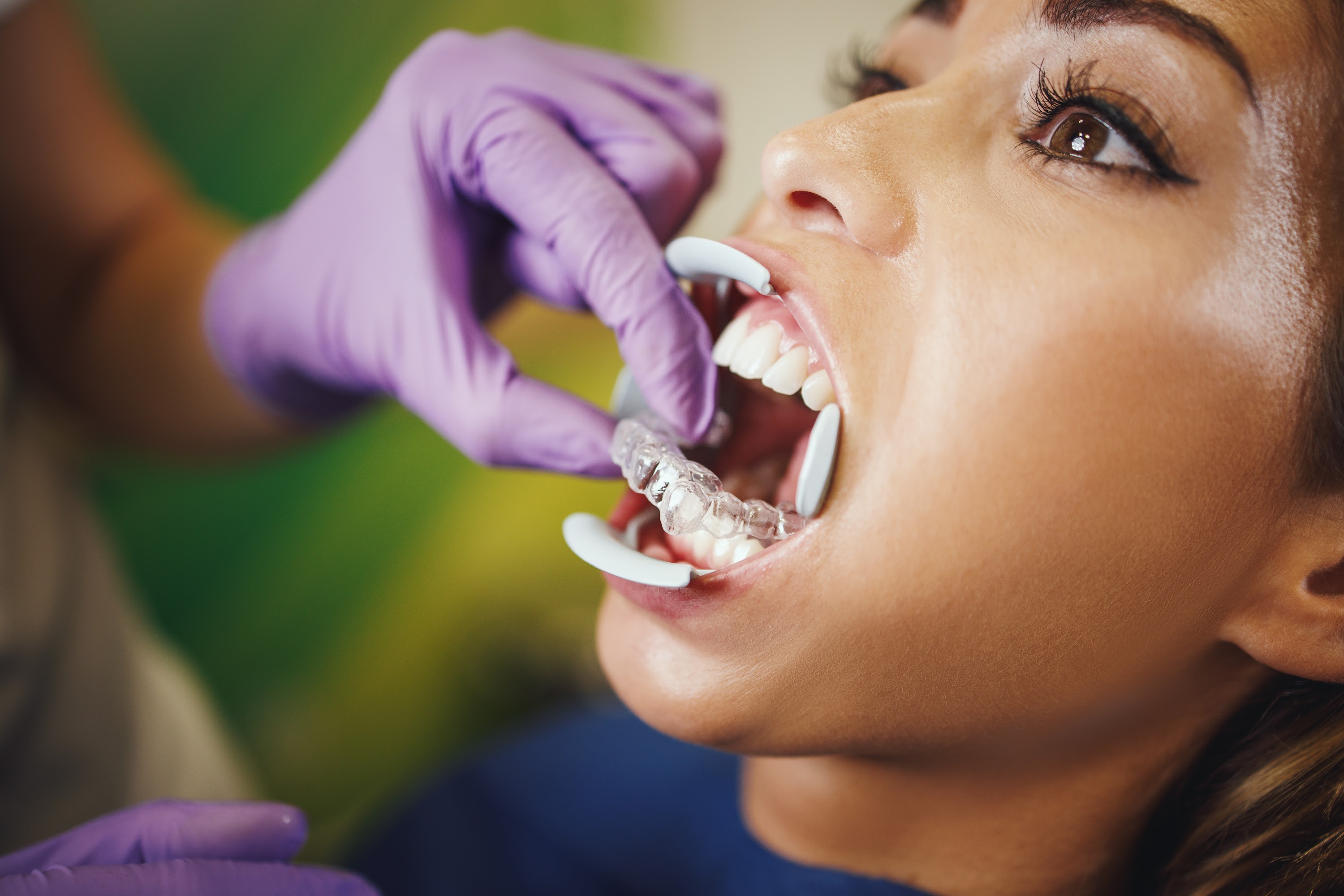 indirect-bonding-aesthetic-lingual-braces-2024-10-18-09-05-58-utc.jpg