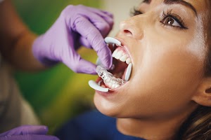 indirect-bonding-aesthetic-lingual-braces-2024-10-18-09-05-58-utc.jpg