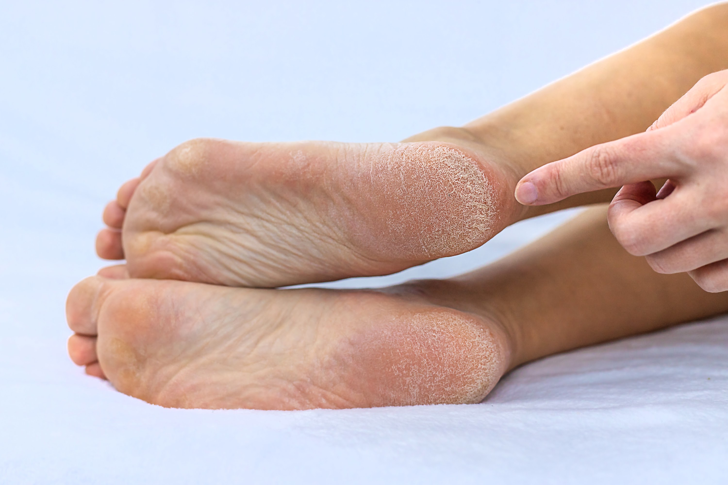 female-feet-dry-skin-on-the-heels-selective-focus-2024-12-19-20-02-45-utc.JPG