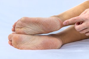 female-feet-dry-skin-on-the-heels-selective-focus-2024-12-19-20-02-45-utc.JPG